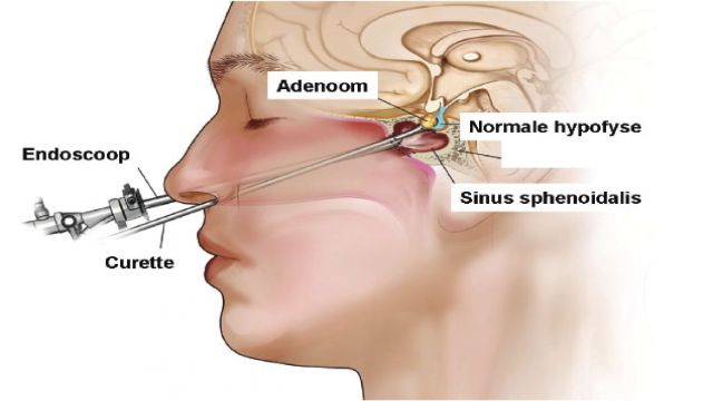 Adenom Nedir? Belirtileri Ve Tedavi Yöntemleri Neler? Adenom Ve Karninom Arasındaki Farklar