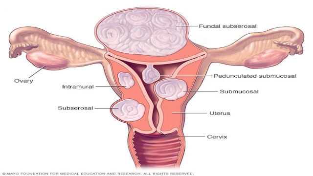 Uterin Fibroid Nedir? Uterin Fibroid Ne İşe Yarar? Uterin Fibroid Belirtileri Nedir? ve Tedavisi?